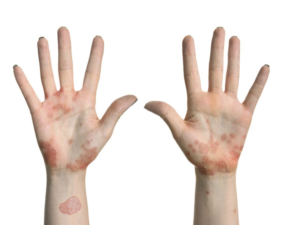 Psoriasis in the hands